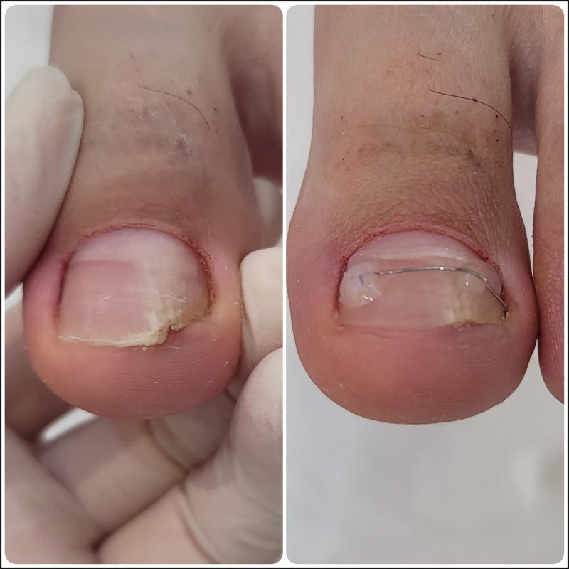 천안 내성발톱 전문 관리, 레푸스 두정점에서 통증없이 확실하게!