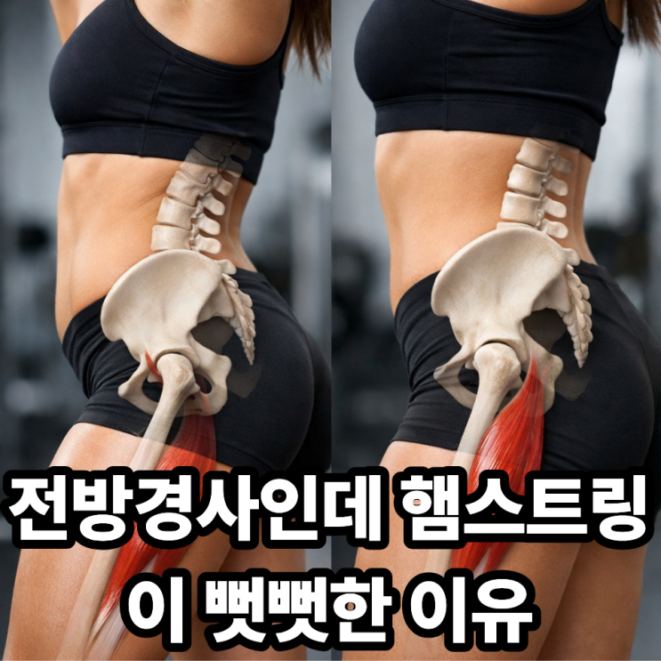  골반 전방경사와 햄스트링의 관계, 왜 같이 관리해야 할까?