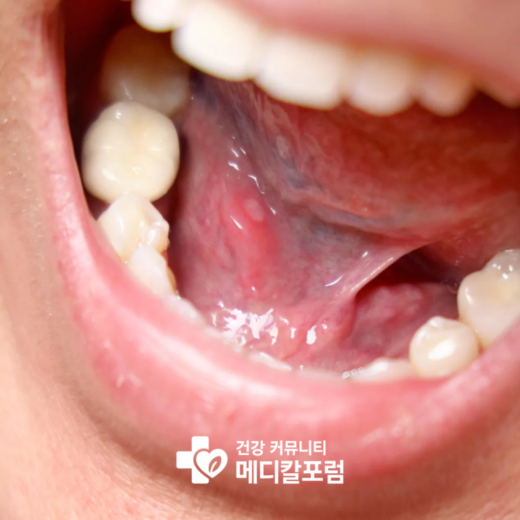  입안이 쓴이유 위식도 역류성 식도염, 구강 건조증, 아연 결핍