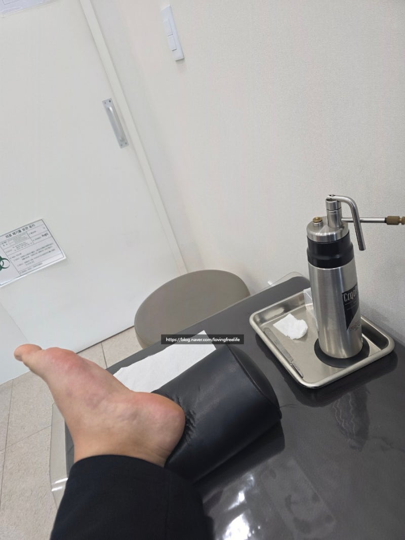 사마귀 냉동치료 후기 발바닥 통증, 가격, 실비여부