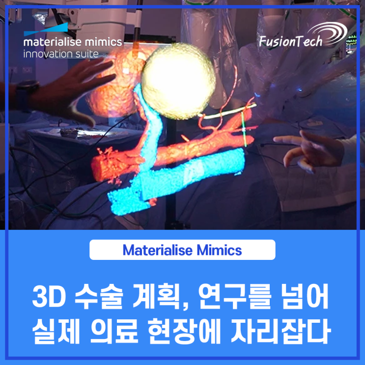  [Materialise S/W] 연구를 넘어 실제 의료 현장에 자리잡은 3D 수술 계획