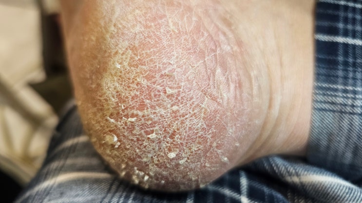  발뒤꿈치 갈라짐 무좀 아니야? 당뇨병 각질 상관 관계 당뇨 초기 증상 및 관리
