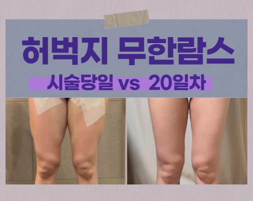  성북구 무한람스 당일 기억하며 써보는 허벅지 람스 20일 차 후기