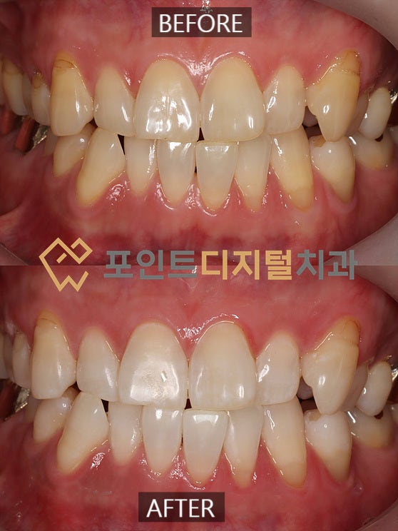 [탕정치과]  중장년층의 치아미백(미백폭발 코스) / 천안 아산 불당 배방