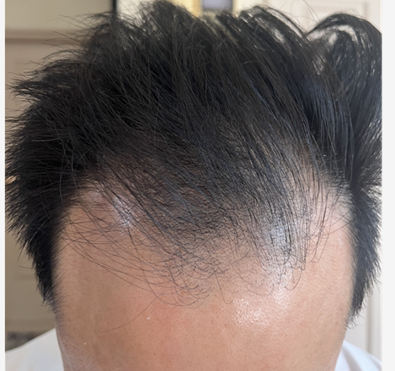  터키 모발이식 후 8개월차 까지의 경과 후기