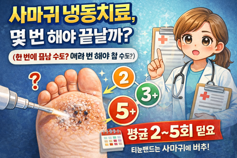 사마귀 냉동치료, 몇 번 해야 끝날까요? 현실적인 답변