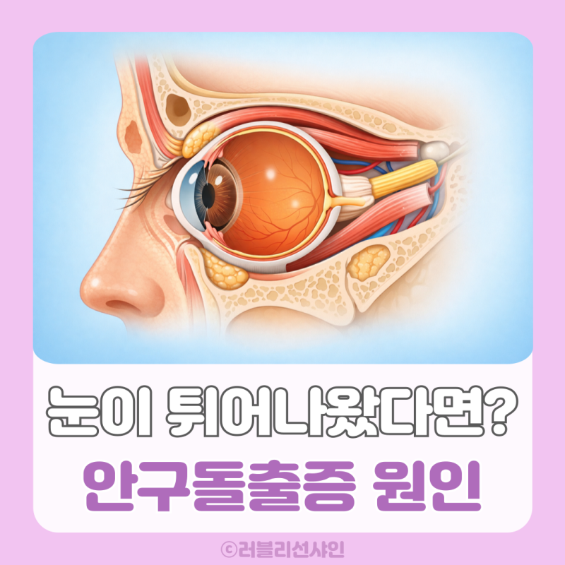 안구돌출증 증상 원인 치료 정리