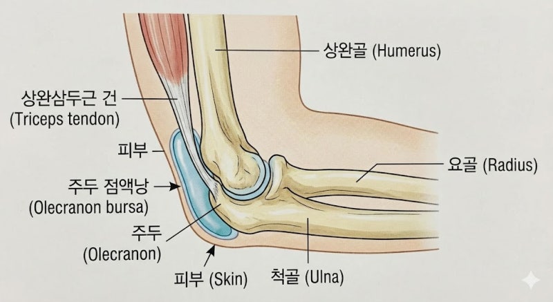 [팔꿈치 혹] “팔꿈치에 물풍선이 생겼어요!” 주두 점액낭염(Olecranon bursitis), 주사기로 빼면 ....