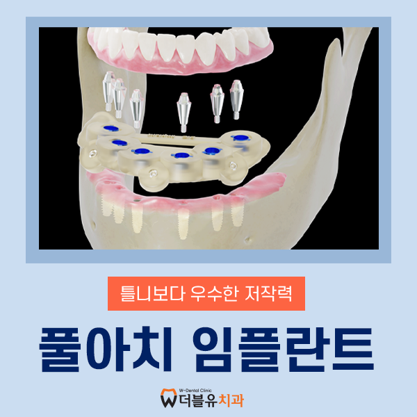 풀아치 임플란트란? 과정, 기간, 가격