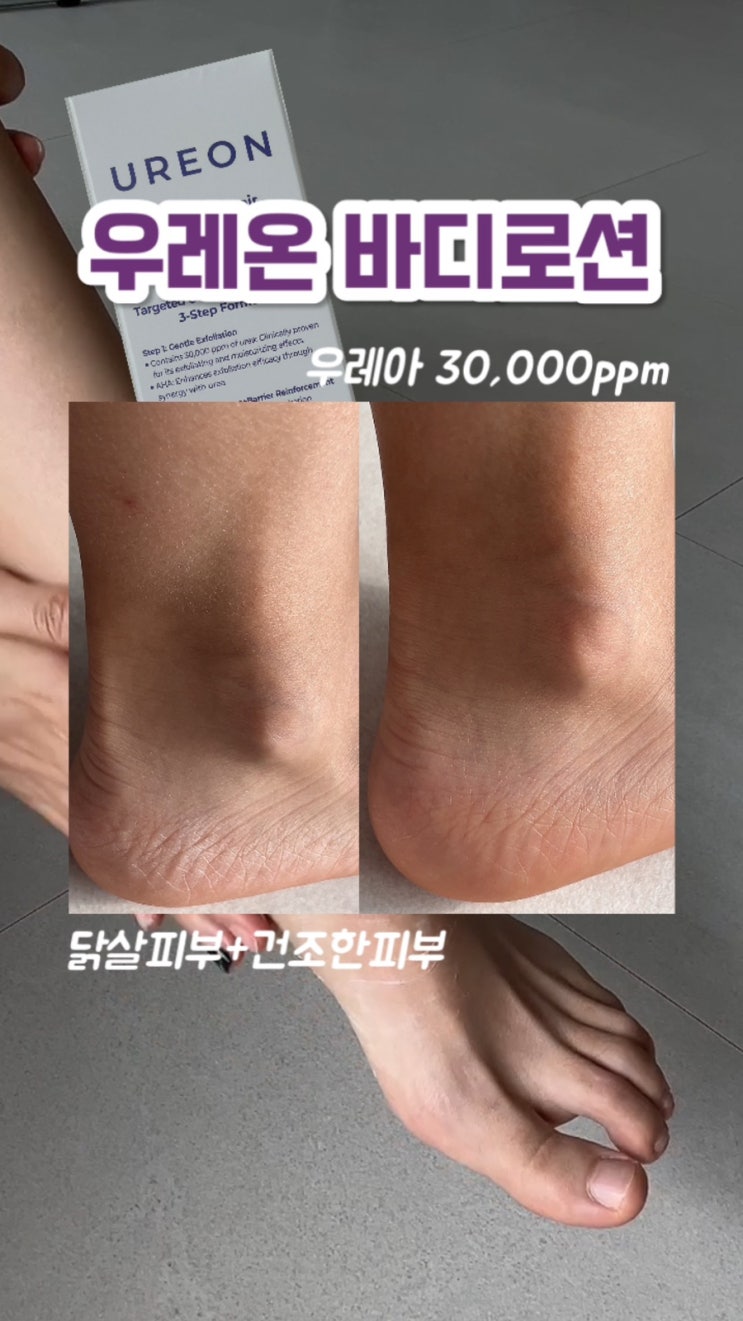  닭살피부 개선하기 30,000ppm 함량 우레아바디로션 추천