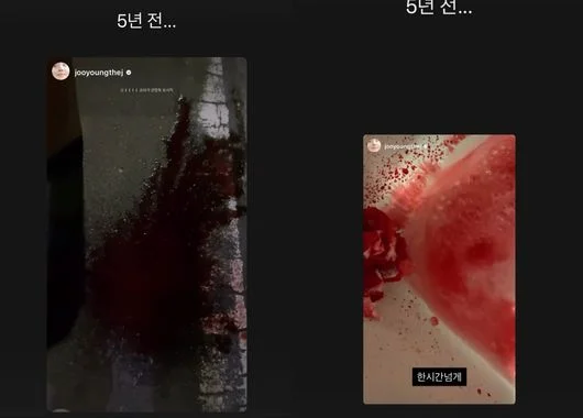 '수술로 활동중단' 차주영, 심각한 출혈 "1시간 넘게 안멈춰"…피 '흥건' 충격