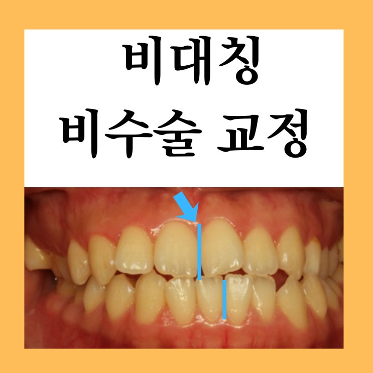 창동교정치과, 수술 없이 비대칭 개선 가능할까요?(비대칭 비수술 교정)