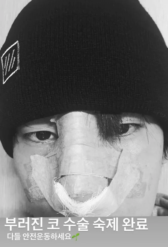 '강철부대' 육준서, 부러진 코 재건 수술 완료… "C자 휘어짐 드디어 교정"