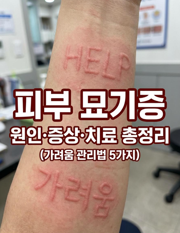 피부 묘기증 원인, 증상, 치료 총정리 (가려움증 관리법 5가지)