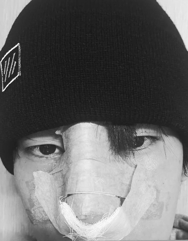 육준서 “코 수술 숙제 완료”…C자로 휘었던 코, 재건술 근황 공개