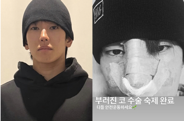 육준서, 복싱 경기 부상 후 코 수술 사진 공개…후유증+회복 계획 전격 공개
