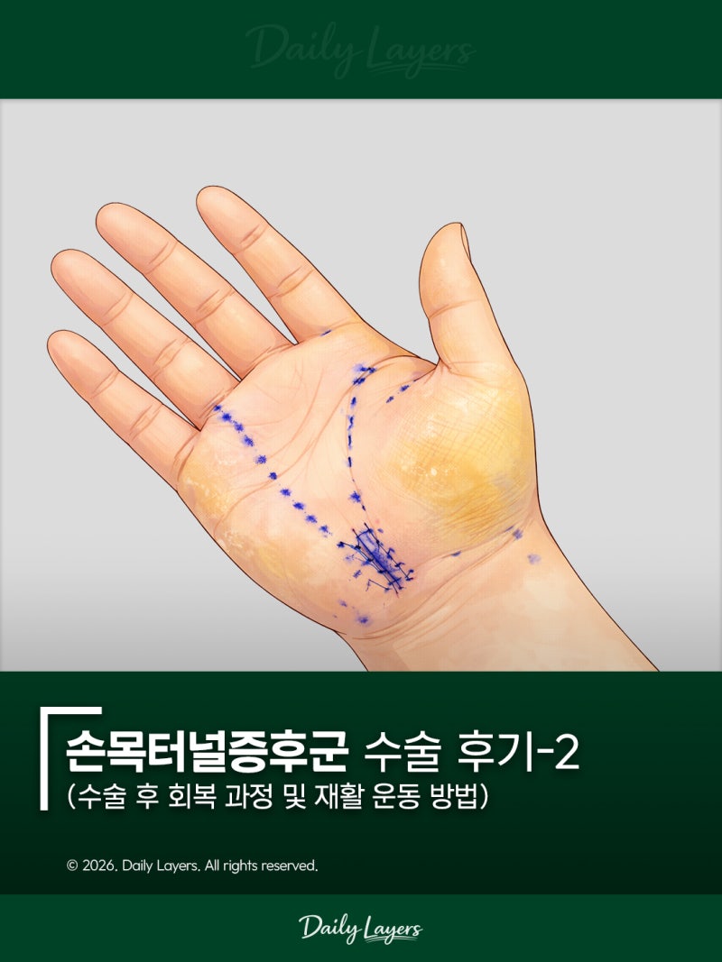 손목터널증후군 수술 후기-2 - 회복 과정 및 재활 운동