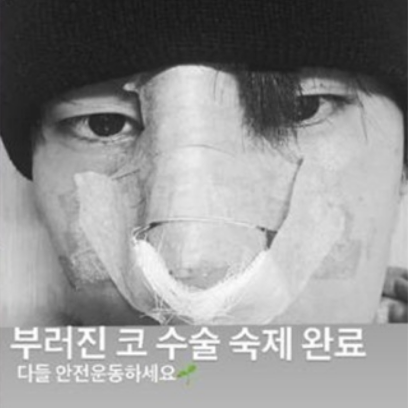“조각 코가 ‘C자’ 됐다 육준서, 결국 수술대 ‘붕대 셀카’ 공개”