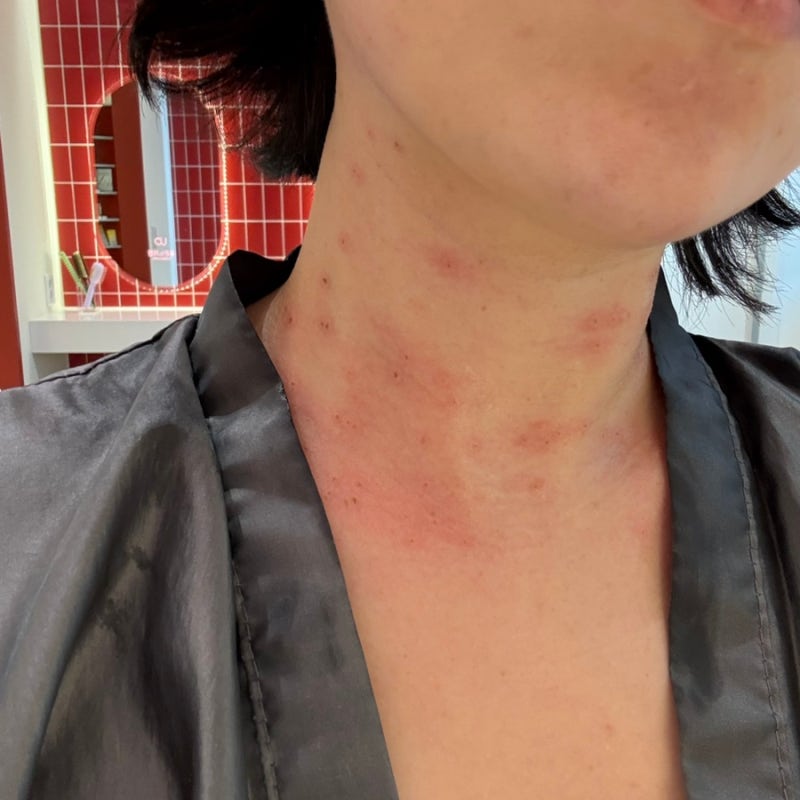 신촌 편사 성지 비립종 편평사마귀 내돈내산 제거 후기 / 듀오덤 알러지