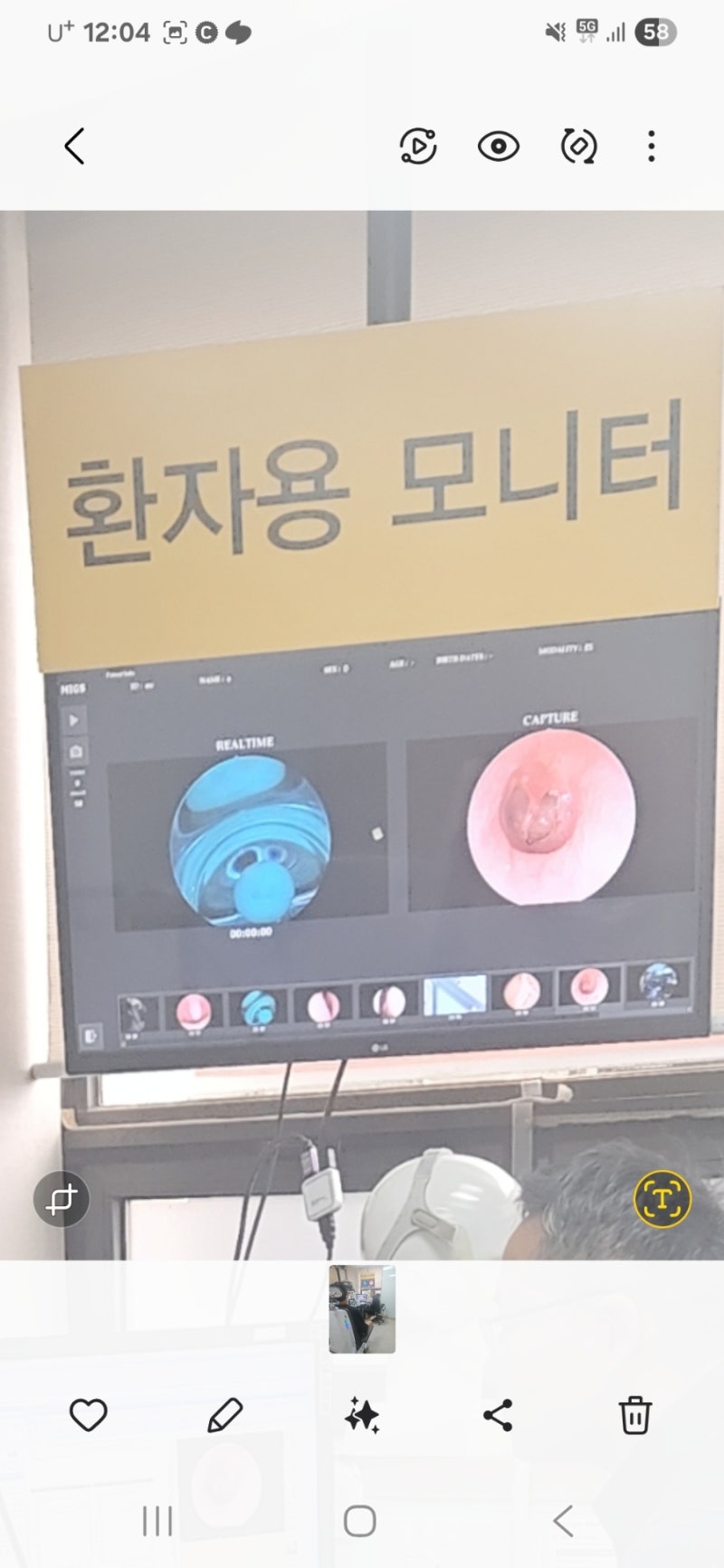 고막터지면or고막찢어지면 고막재생수술. 고막재건술 수술후기