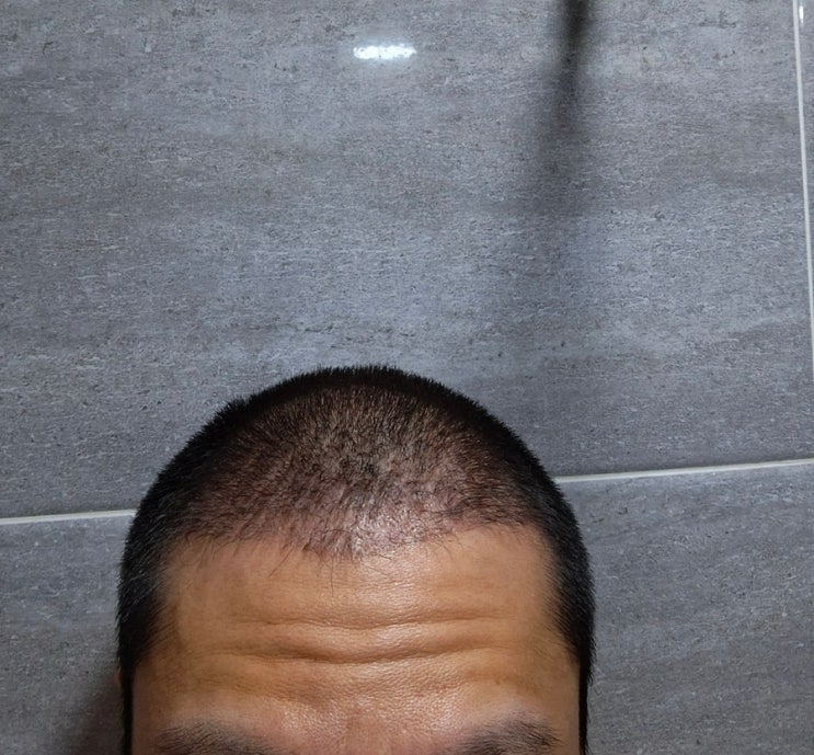  3개월차가 된 터키 모발이식