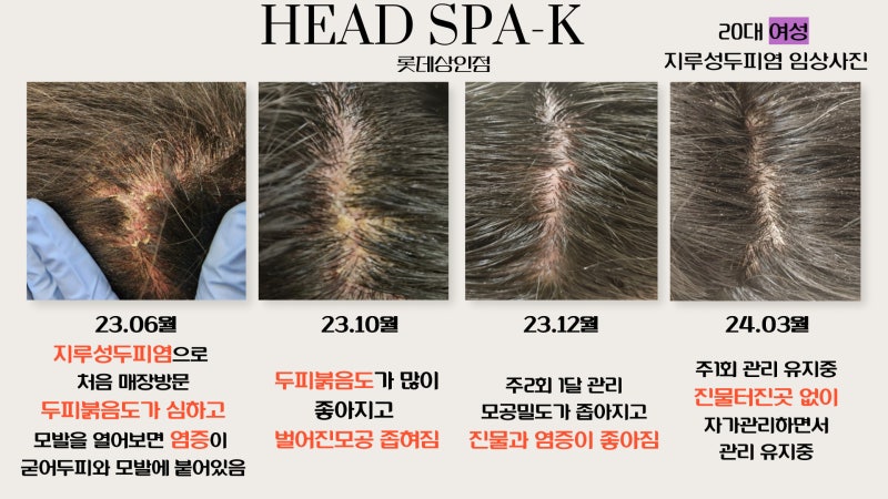 대구 지루성두피염, 병원과 두피관리실 차이 비교