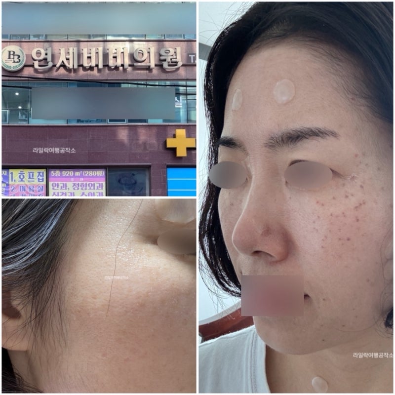 전주 흑자 리팟레이저 연세비비의원 리얼후기 평편사마귀 기미 상담 시술 사후관리