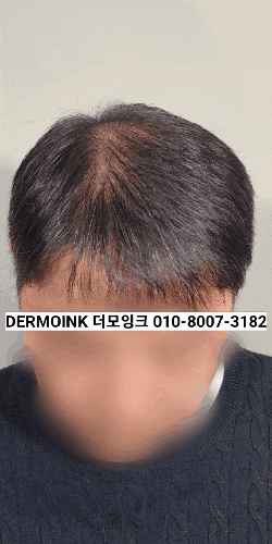  수원 영통 탈모 두피 커버 후기 실제 사례로 보는 전후 차이