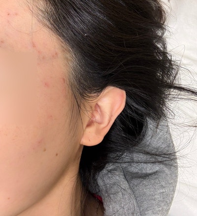  대구 중구 피부관리 페이즈 스킨케어에서 비립종, 편평사마귀 후기