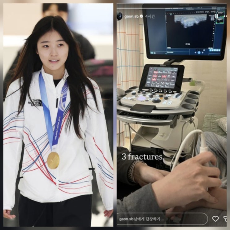 최가온 세 군데 골절 투혼의 금메달 프로필 근황