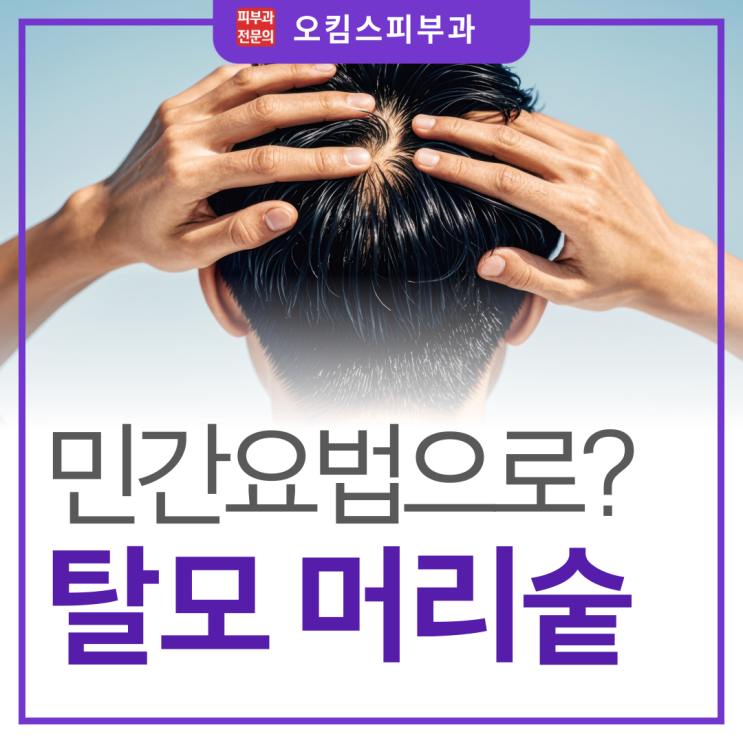  마두역탈모병원 남자 여자 머리숱많아지는법, 과연 민간요법으로 될까?
