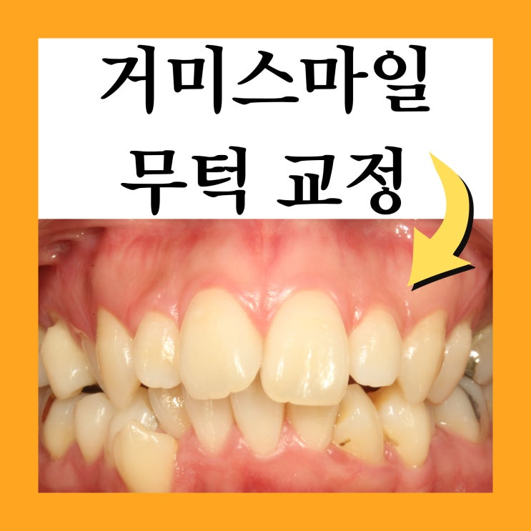  노원치아교정추천, 잇몸 많이 보이는 거미스마일과 무턱 교정