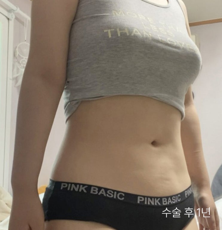  복부 러브핸들지방흡입 옆구리 군살까지 정리하고 싶다면
