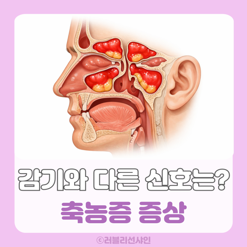 축농증 증상 원인 치료, 전염 여부와 자가진단 체크리스트