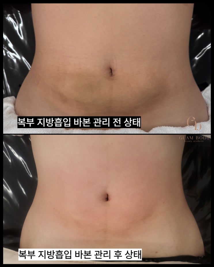  복부 지방흡입 바본 관리 전후｜아랫배가 나온 느낌, 왜 그럴까요?