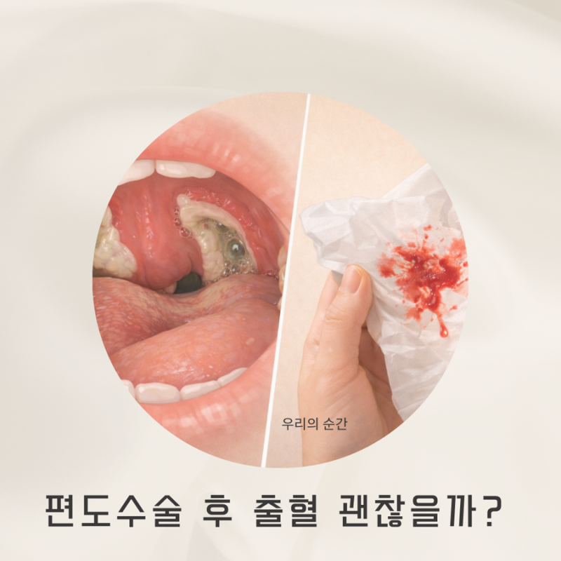 편도수술 후 출혈, 괜찮을까? 7~10일차 지연출혈 대처법