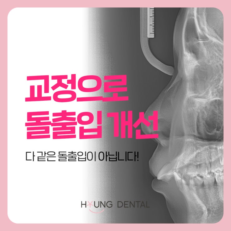  매탄동 교정치과 돌출입에 대해 알려드립니다