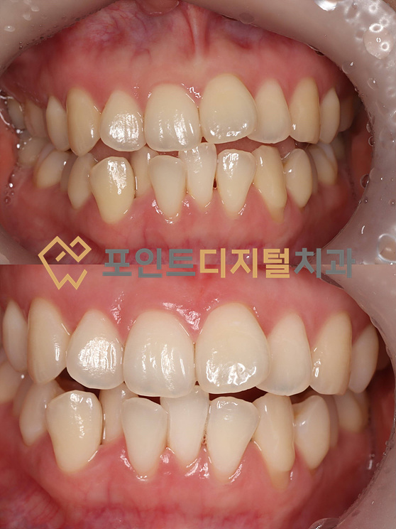  [탕정치과]  오스템 뷰티스 원데이 치아미백 케이스 / 천안 아산 불당 배방