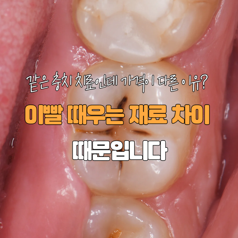 이빨 때우는 재료 종류 총정리(레진 아말감 인레이 차이점)