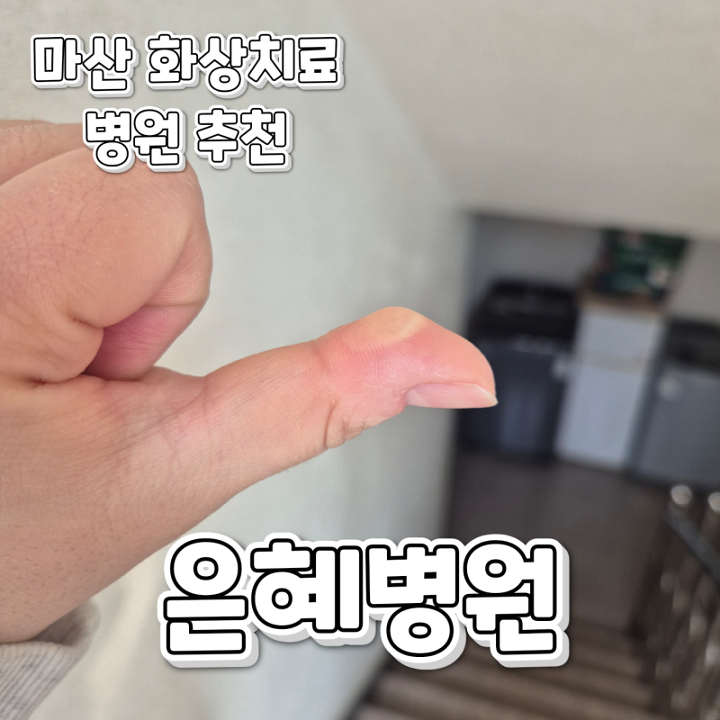 창원화상치료후기)마산 은혜병원 2도 화상치료 및 셀프 화상 치료 후기