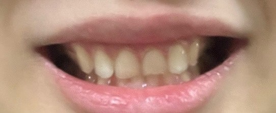 잇몸레이저 (잇몸성형), 거미스마일보톡스 후기