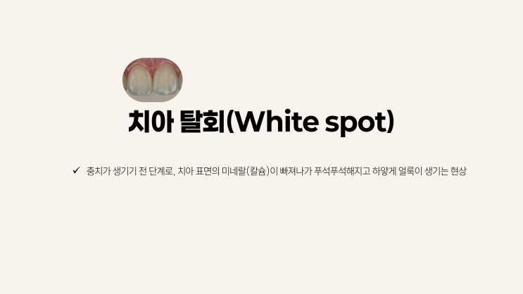  교정 합병증, 하얀 반점(white spot) '치아 탈회'의 예방과 치료법, 교정 후 옥에 티?