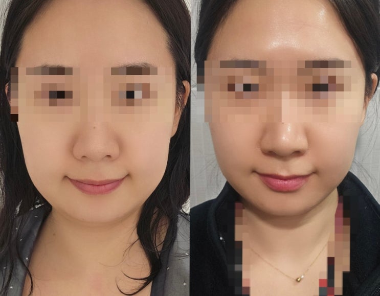  침산동피부과 대구텐써마 300샷 전후 후기 고현정리프팅 효과 2주 경과 턱라인 리얼변화