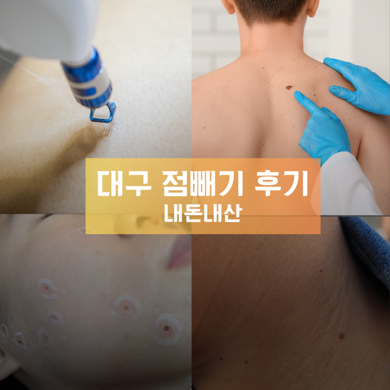 대구 점 빼기 쥐젖 제거 성지, 아들이 또 점을 빼러 간 이유는?