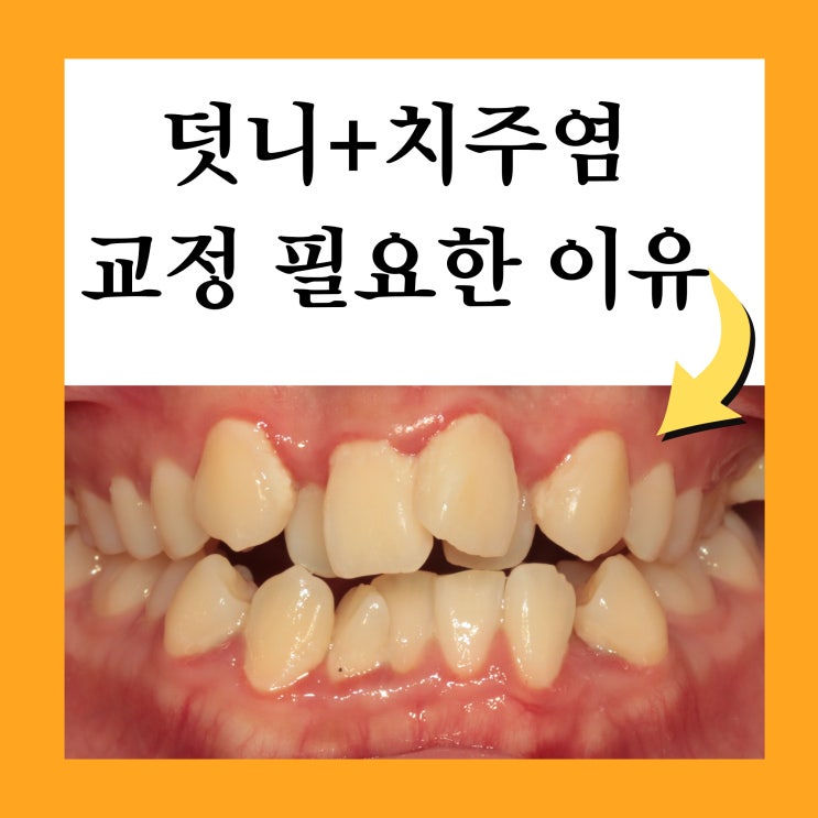  구리교정치과, 덧니 방치하면 생길 수 있는 문제