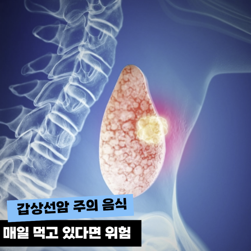 갑상선암 주의 음식 3가지… 1위는 매일 먹는 "이것"