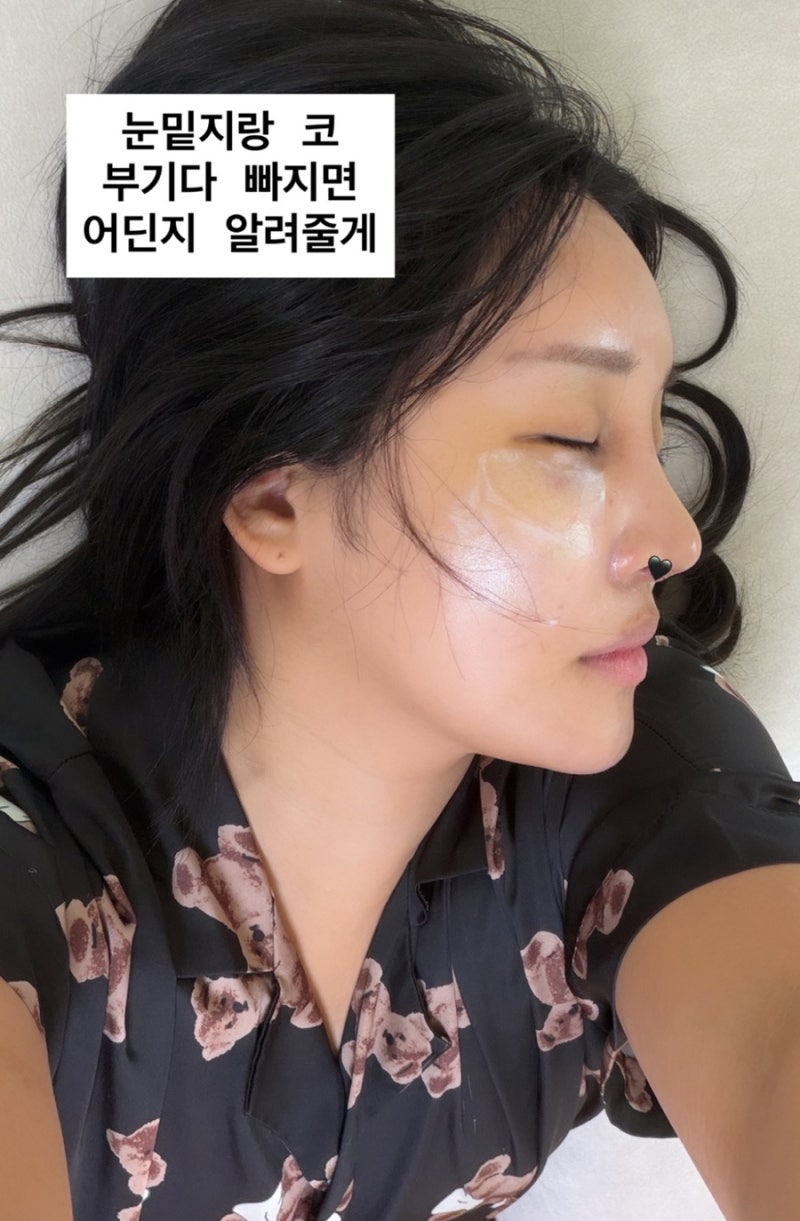 랄랄 코성형,눈밑지 성형후 붓기 빠진 모습 화제 병원이름,어디 성형외과이길래?