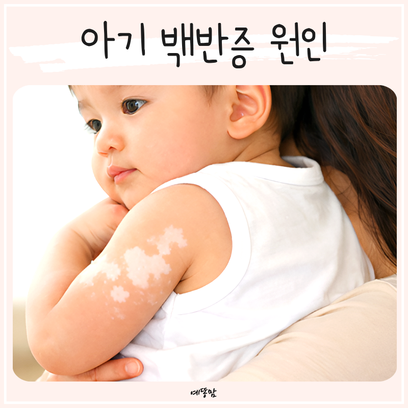 아기 백반증 원인과 치료 방법, 초기 증상부터 관리법까지 정리