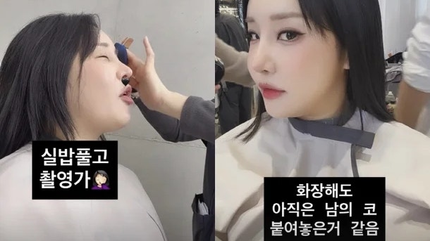 랄랄, 눈코 성형 후 변화 부기 빠졌는데도 어색 남의 코 붙인 느낌