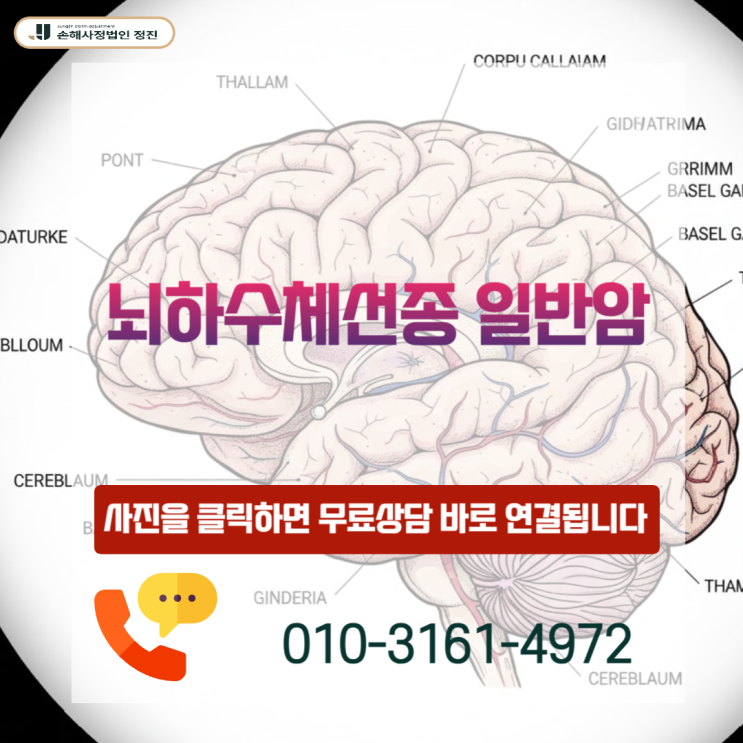  뇌하수체 선종 보험금, D35.2 양성 코드라도 암 진단비 가능할까?